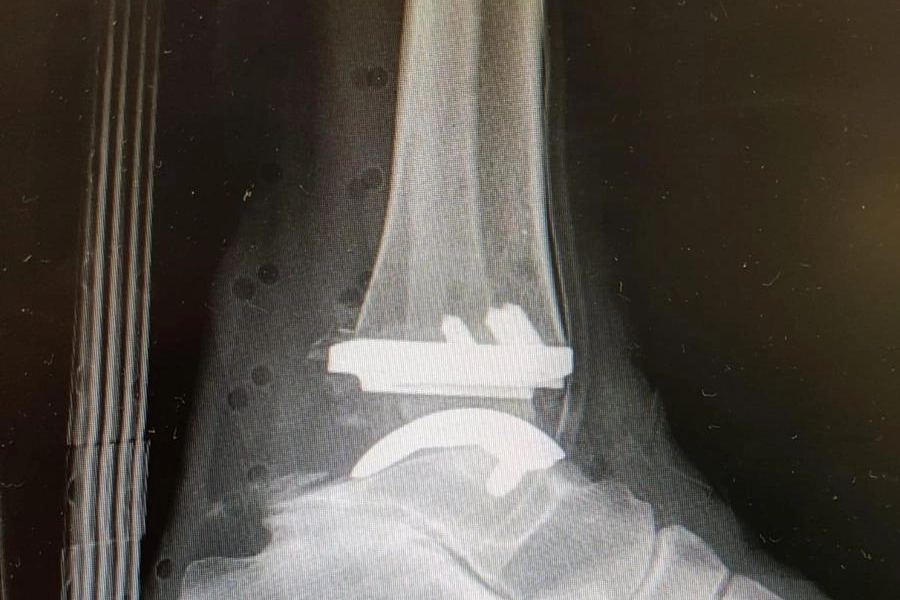 La protesi innestata sulla caviglia