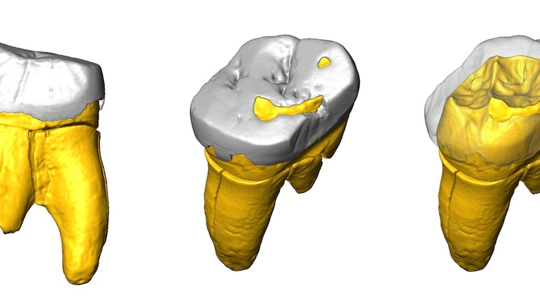 Ricostruzione 3D del dente molare Stajnia S5000