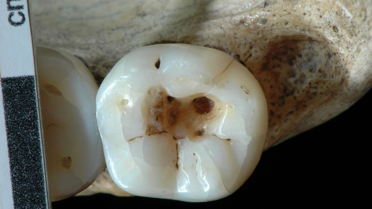 Il terzo molare inferiore dello scheletro trovato sulle Dolomiti Venete