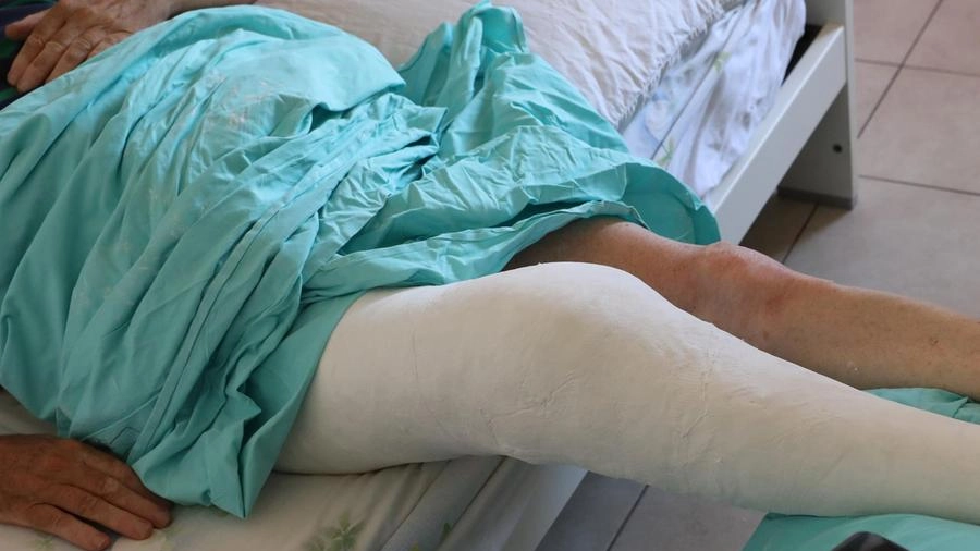 Il pensionato di 72 anni è stato con il gesso alla gamba destra per un mese