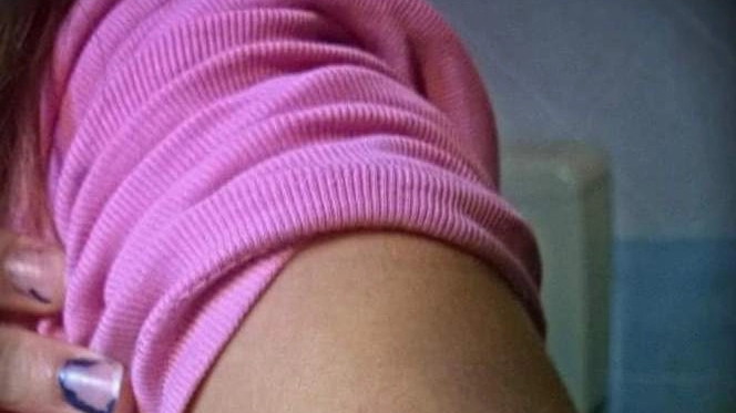 Il braccio della bimba con i segni dei morsi 