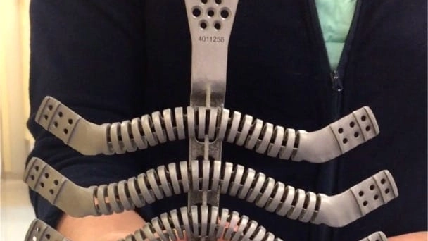 Sterno 3D, la protesi impiantata a una ragazza di 27 anni al Rizzoli