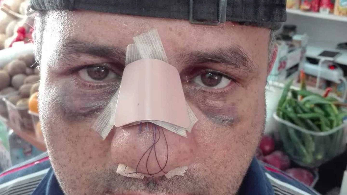 Ahmed ha il setto nasale fratturato. Ha chiesto aiuto ai carabinieri