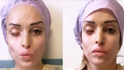 Gessica Notaro, prima e dopo l'intervento all'occhio