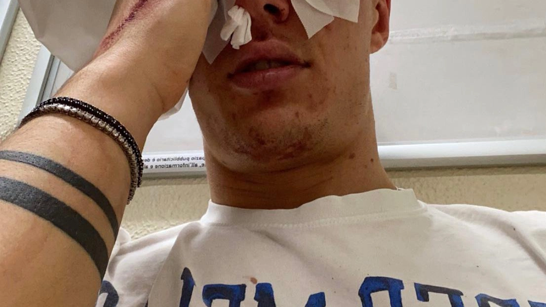 Diego in ospedale, il volto tumefatto dopo l'aggressione