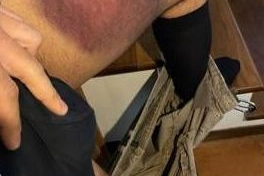 La foto choc della gamba con del 28enne con l’enorme ematoma che inviò ai medici