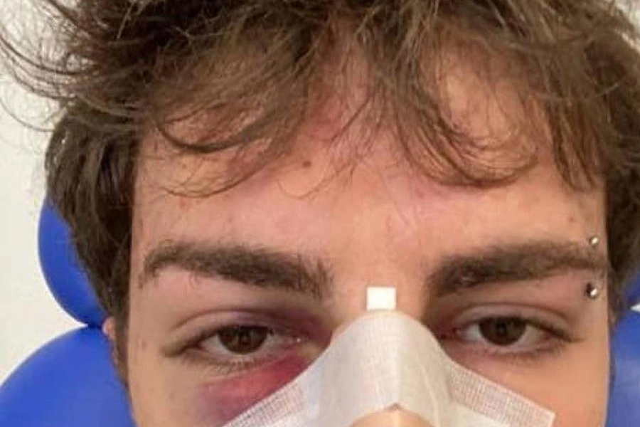 Simone Pasquino di 18 anni col naso fratturato dopo l’aggressione