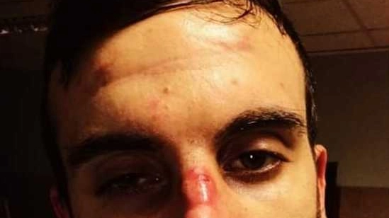 Alessio Olivieri, infermiere ferito dalla mascherina