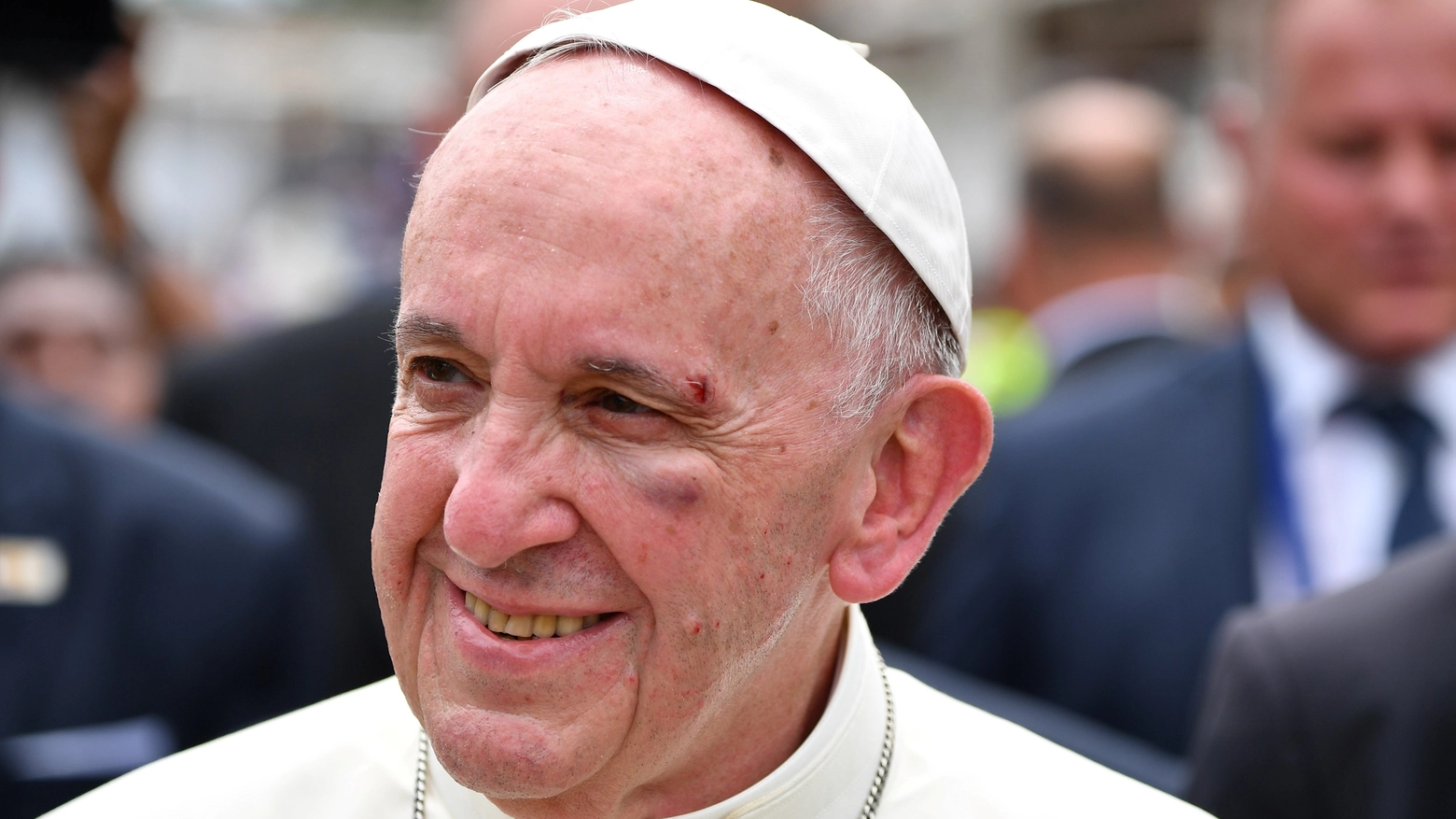 Papa Francesco ferito al viso dopo un incidente in Papamobile (foto Reuters)