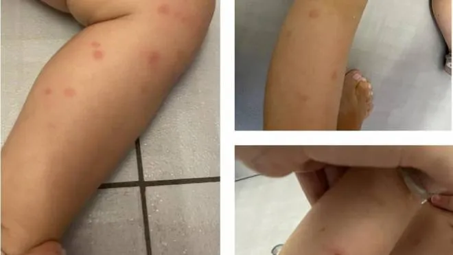 Bambini punti a raffica dalle zanzare, un problema non nuovo per il ’Mongolfiera’